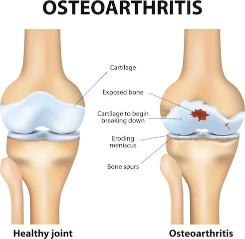 This is an illustration of a healthy knee joint versus is a knee joint with osteoarthritis. Glucosamine sulphate for osteoarthritis can help with pain relief and keep your knee joints healthier.