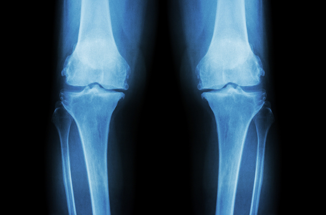This is an x-ray of knee joints that have osteoarthritis. Glucosamine sulphate is a supplement to help with pain relief and slow down the progression of osteoarthritis.